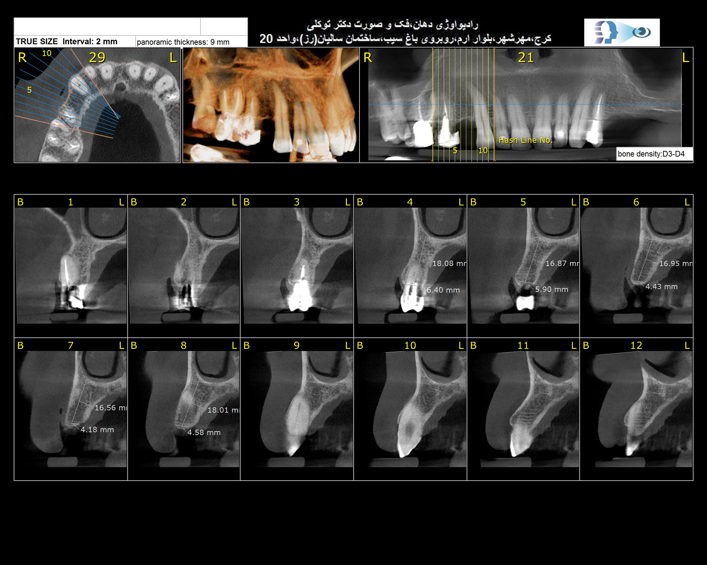 تصویربرداری سه بعدی از فک و دندان(CBCT)
